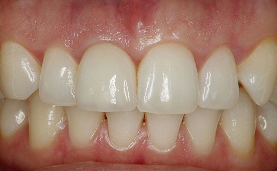 teeth after